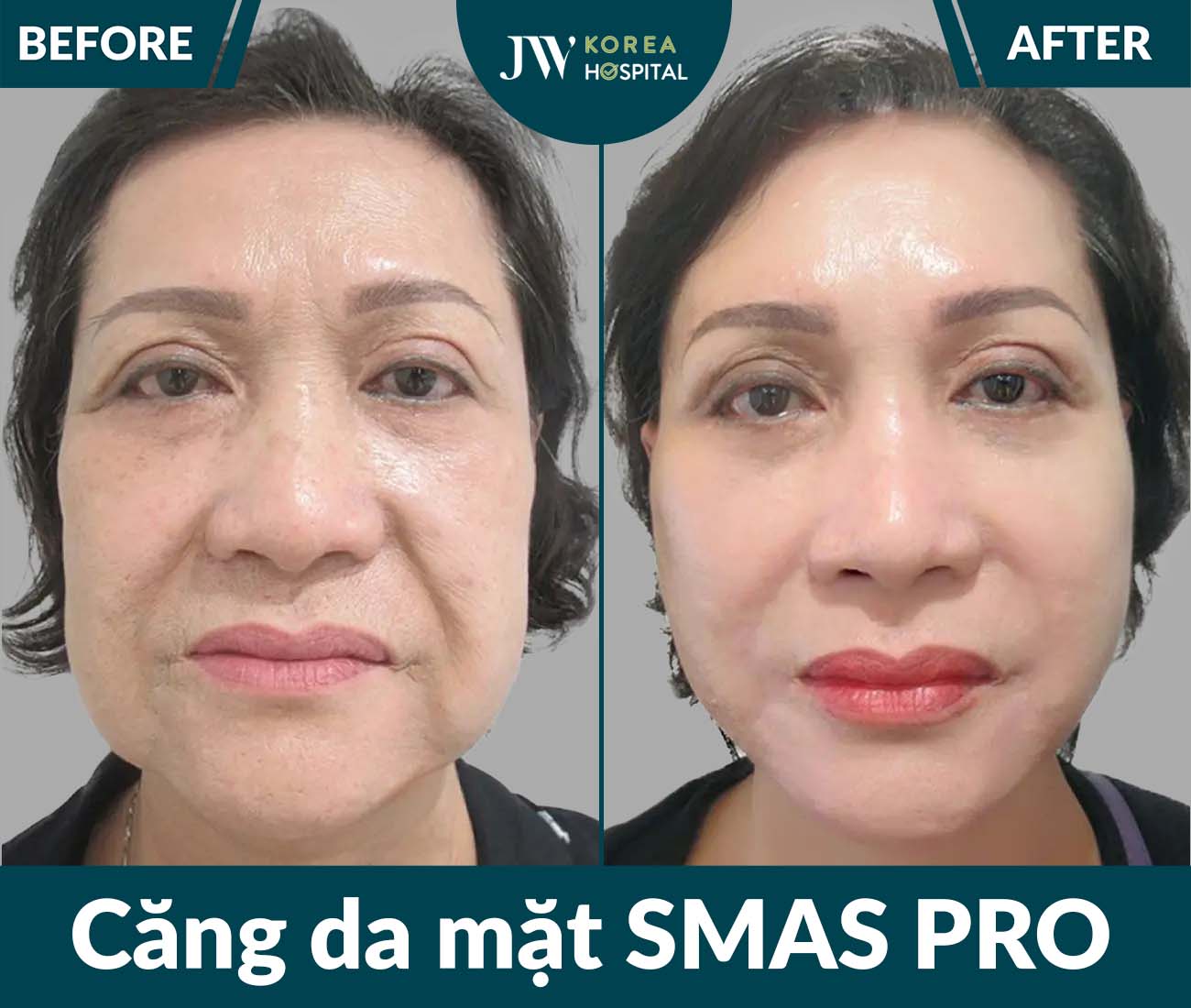 Căng da mặt SMAS PRO