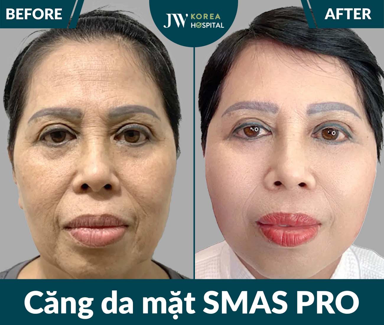 Căng da mặt SMAS PRO