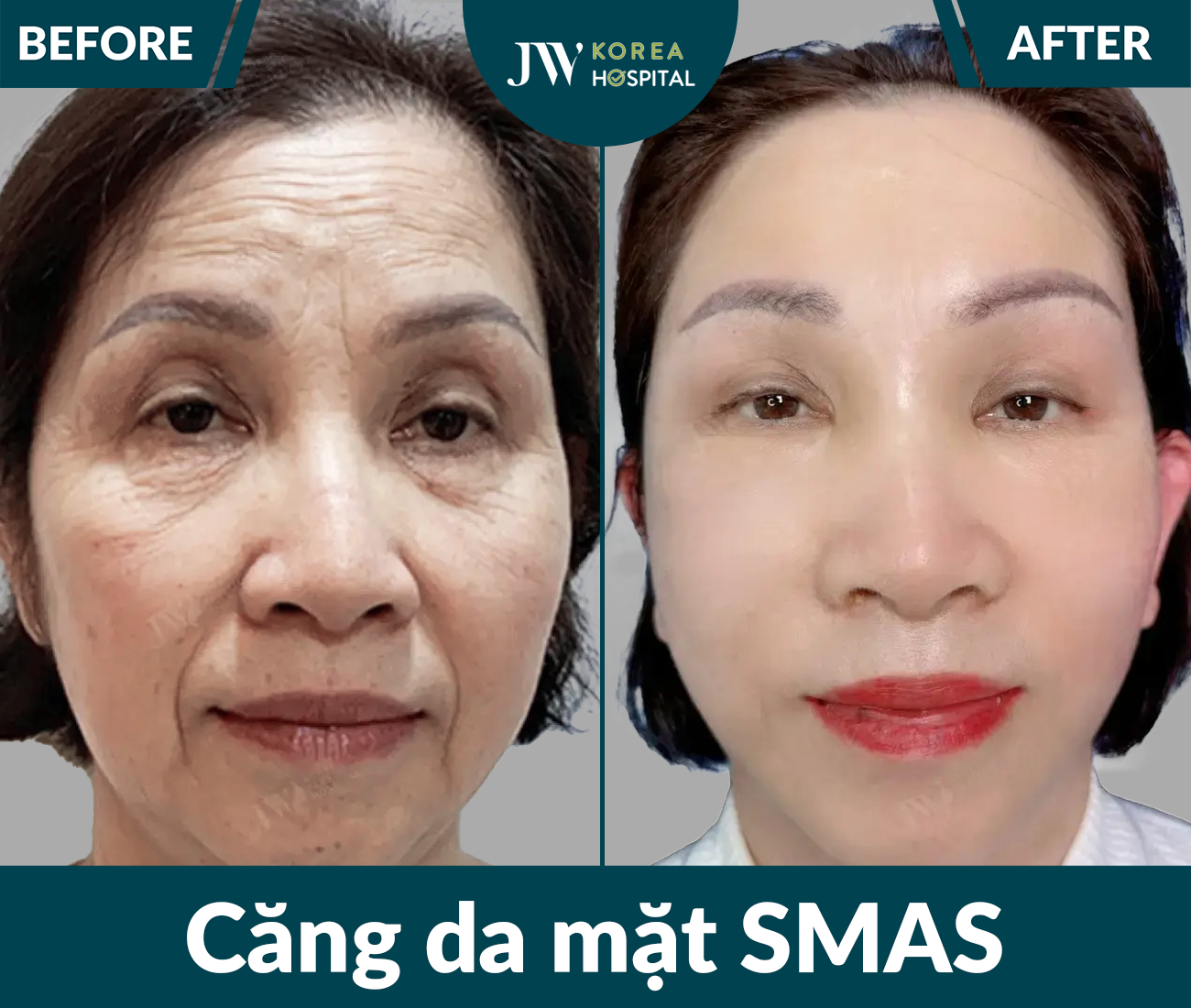 Căng da mặt SMAS PRO