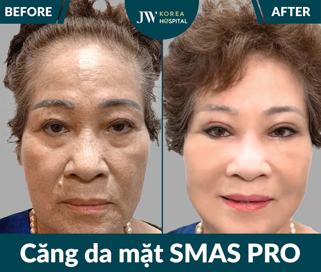 Căng da mặt SMAS PRO