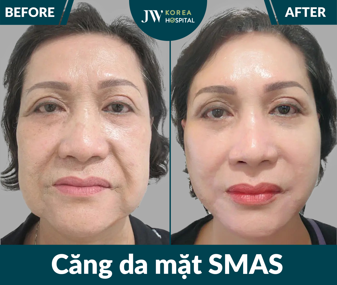 Căng da mặt SMAS PRO