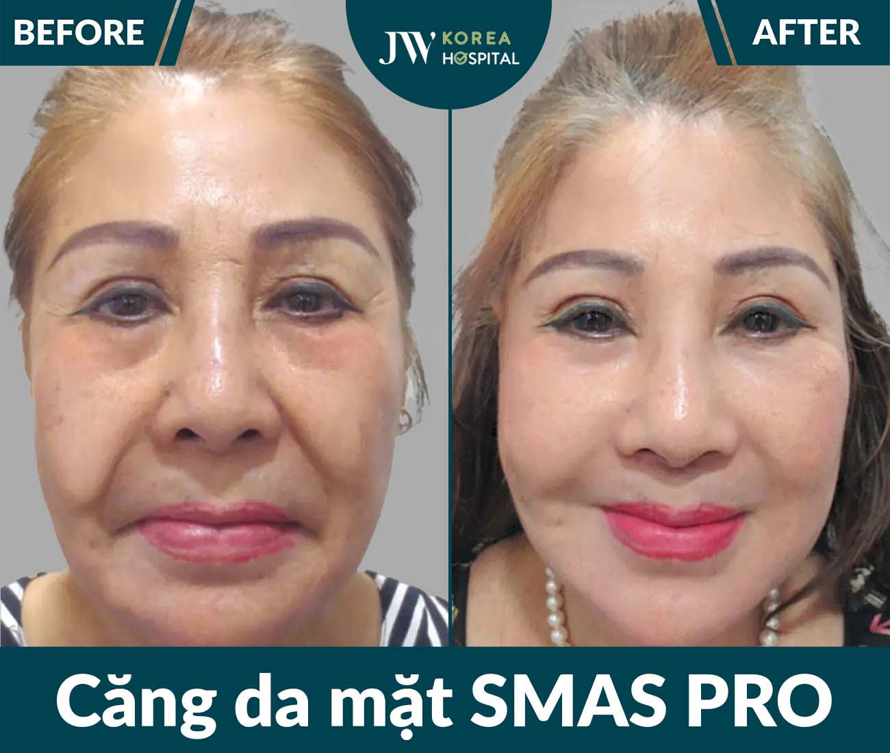 Căng da mặt SMAS PRO