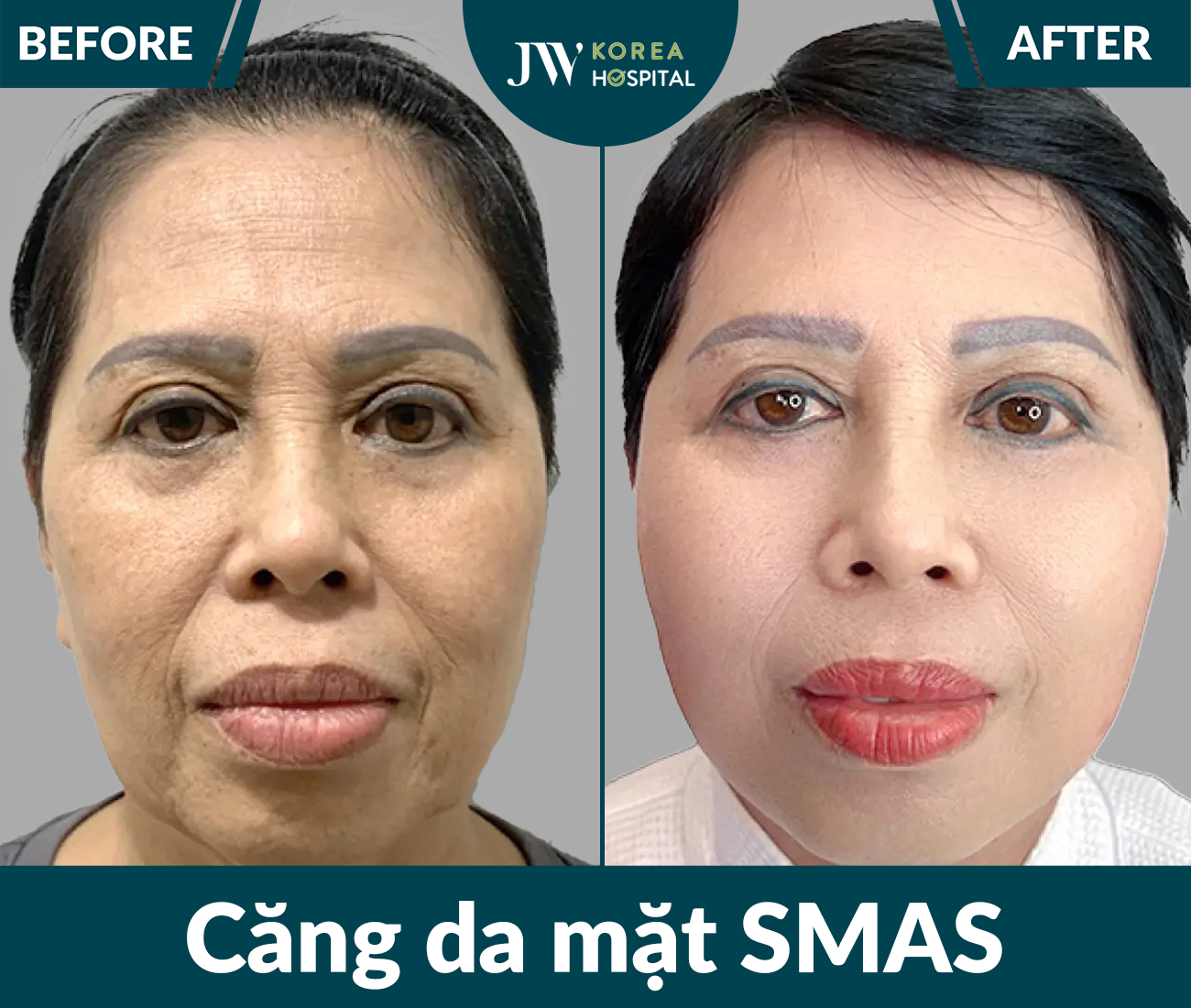 Căng da mặt SMAS PRO