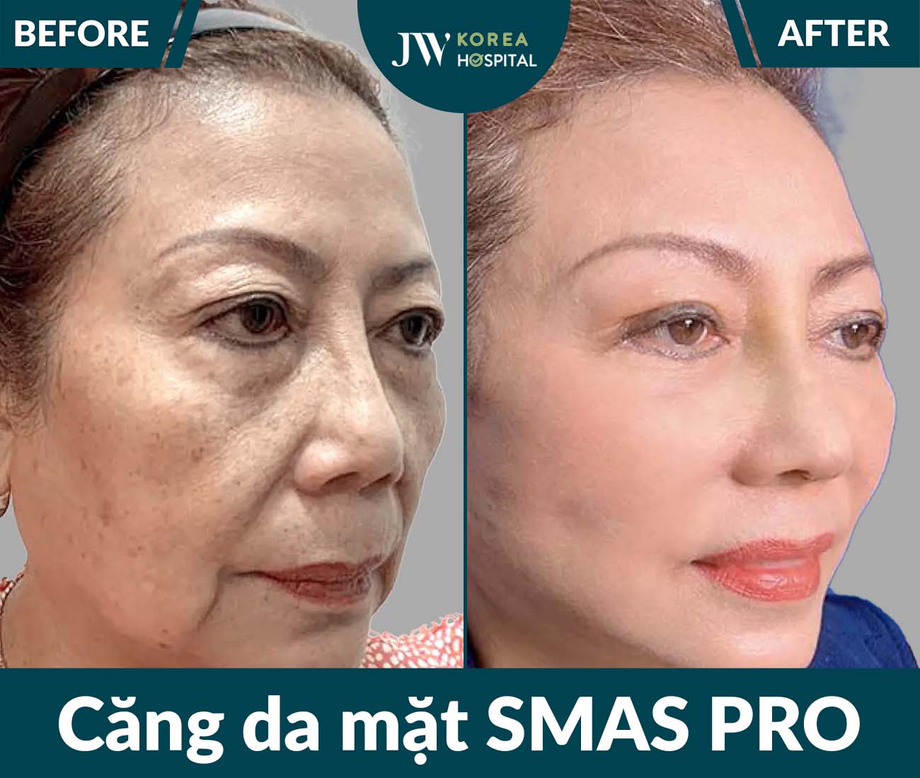 Căng da mặt SMAS PRO
