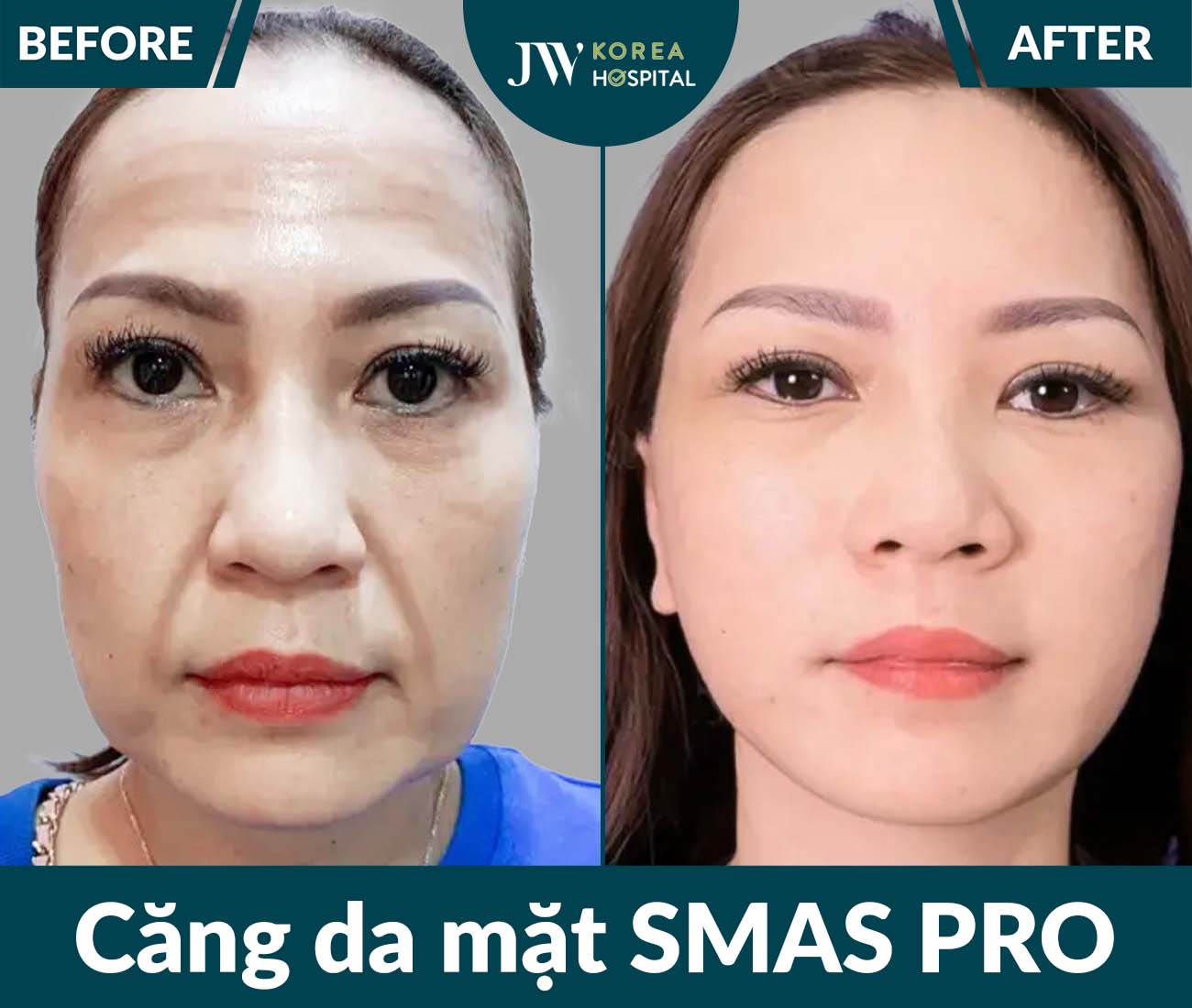 Căng da mặt SMAS PRO