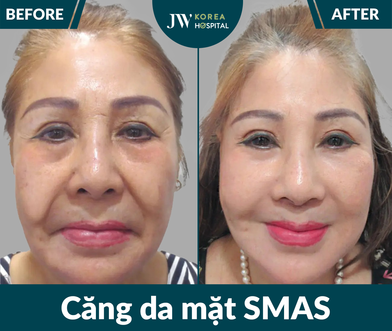 Căng da mặt SMAS PRO
