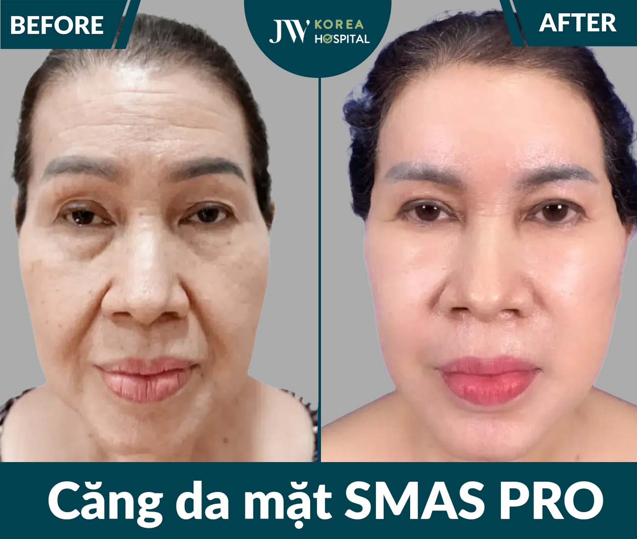 Căng da mặt SMAS PRO