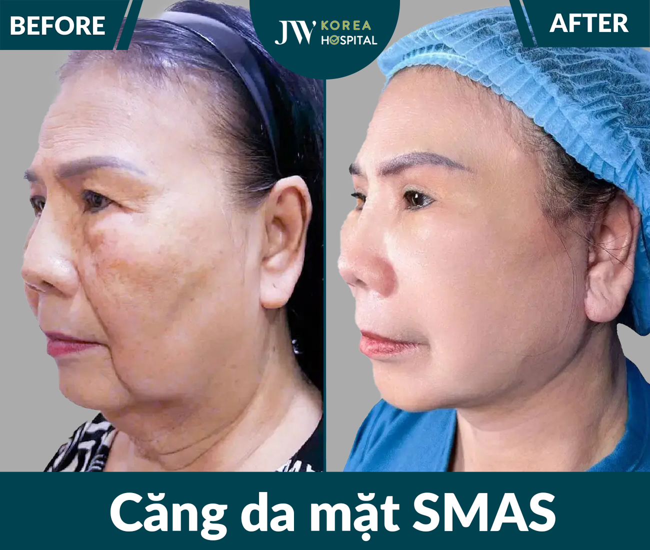 Căng da mặt SMAS PRO
