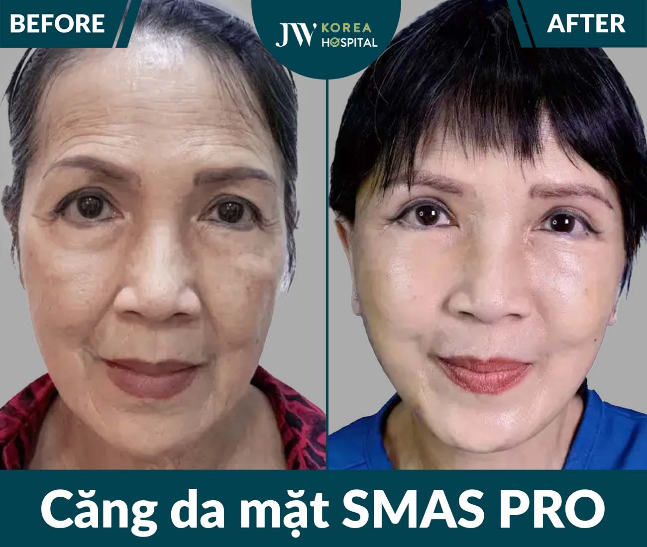 Căng da mặt SMAS PRO