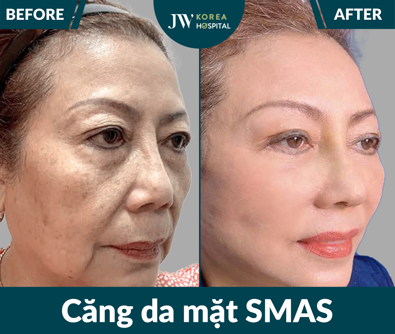 Căng da mặt SMAS PRO