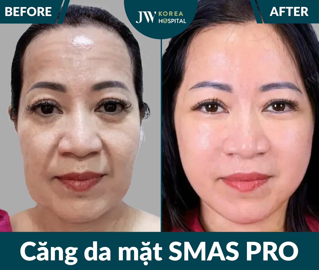 Căng da mặt SMAS PRO