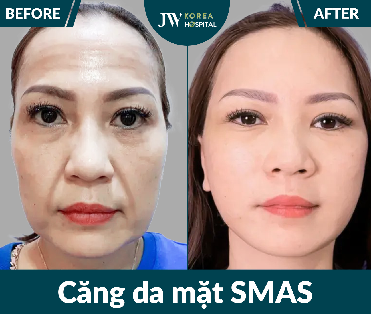 Căng da mặt SMAS PRO