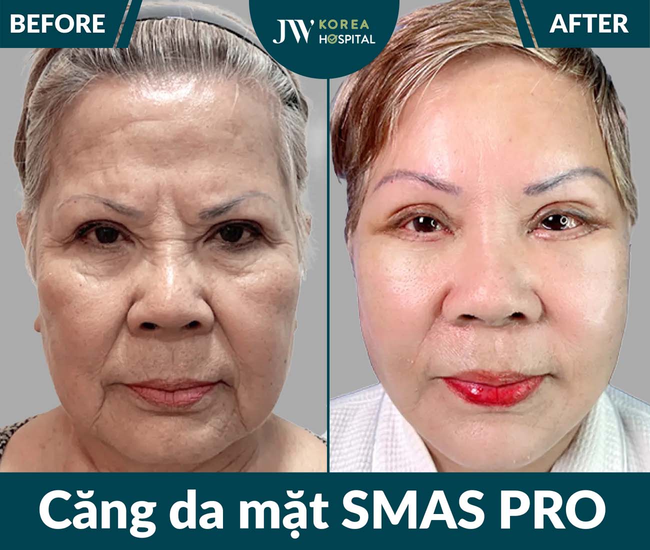 Căng da mặt SMAS PRO