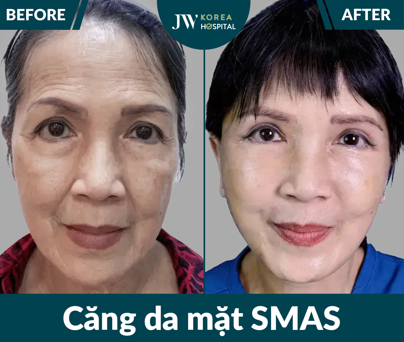 Căng da mặt SMAS PRO