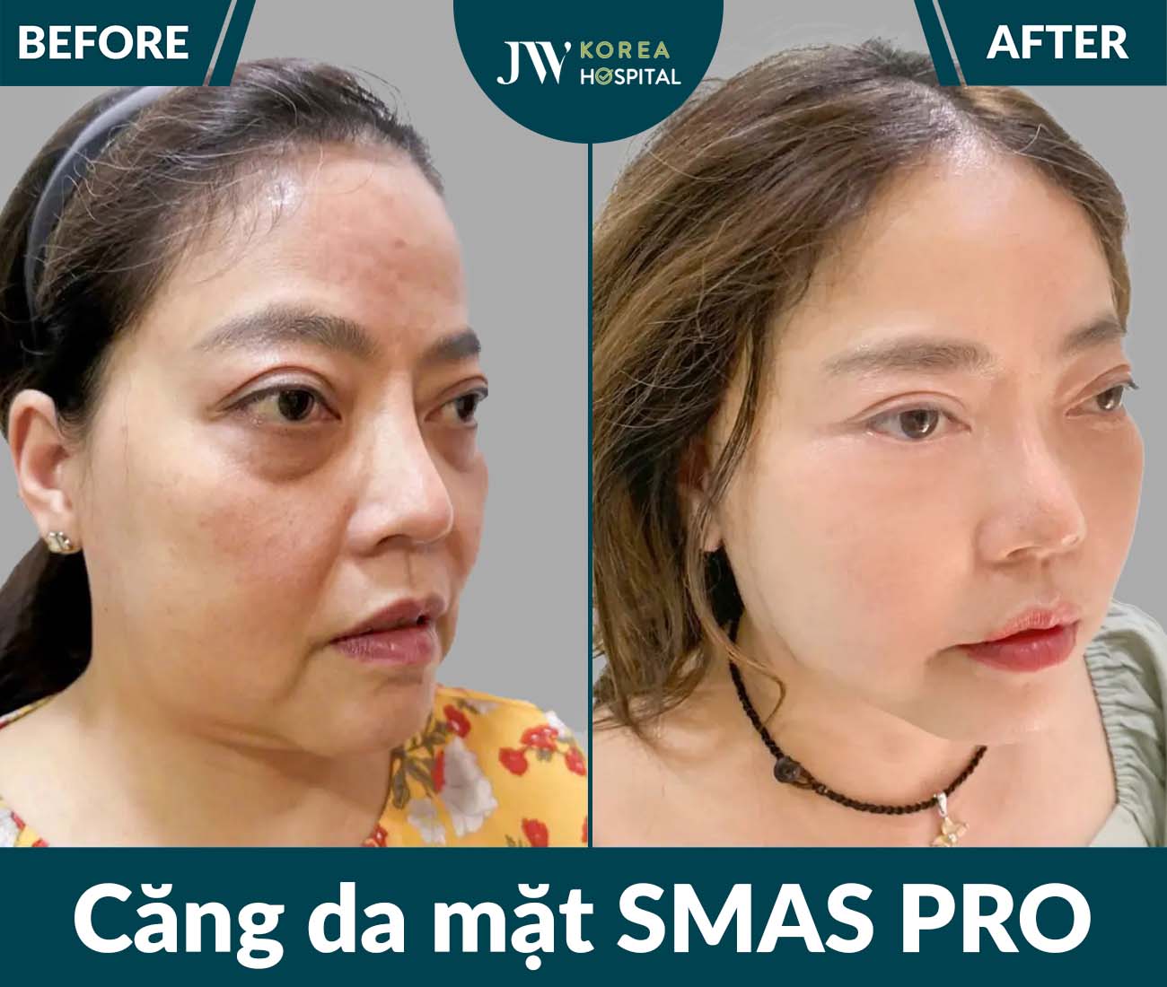 Căng da mặt SMAS PRO