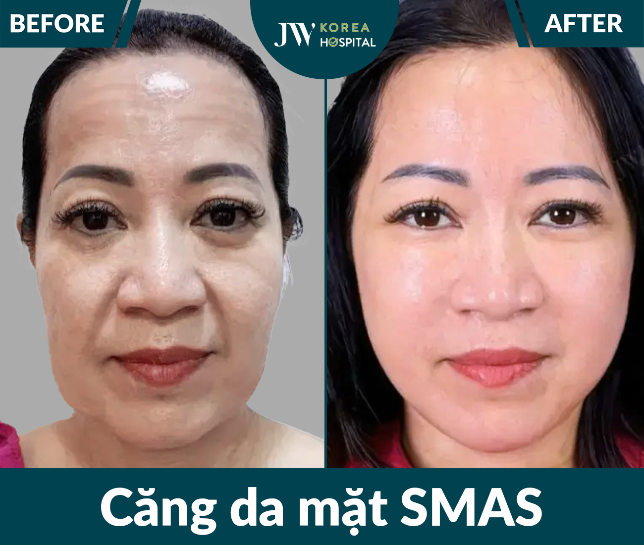 Căng da mặt SMAS PRO