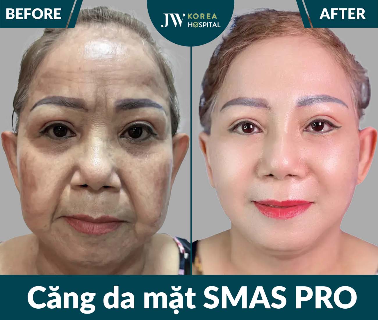 Căng da mặt SMAS PRO