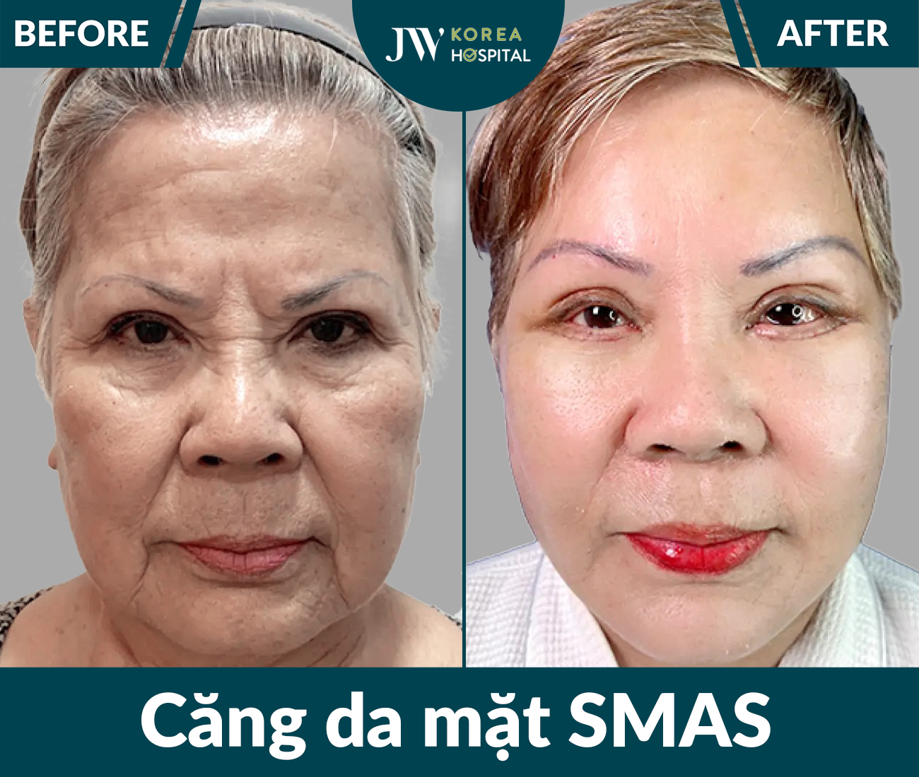 Căng da mặt SMAS PRO