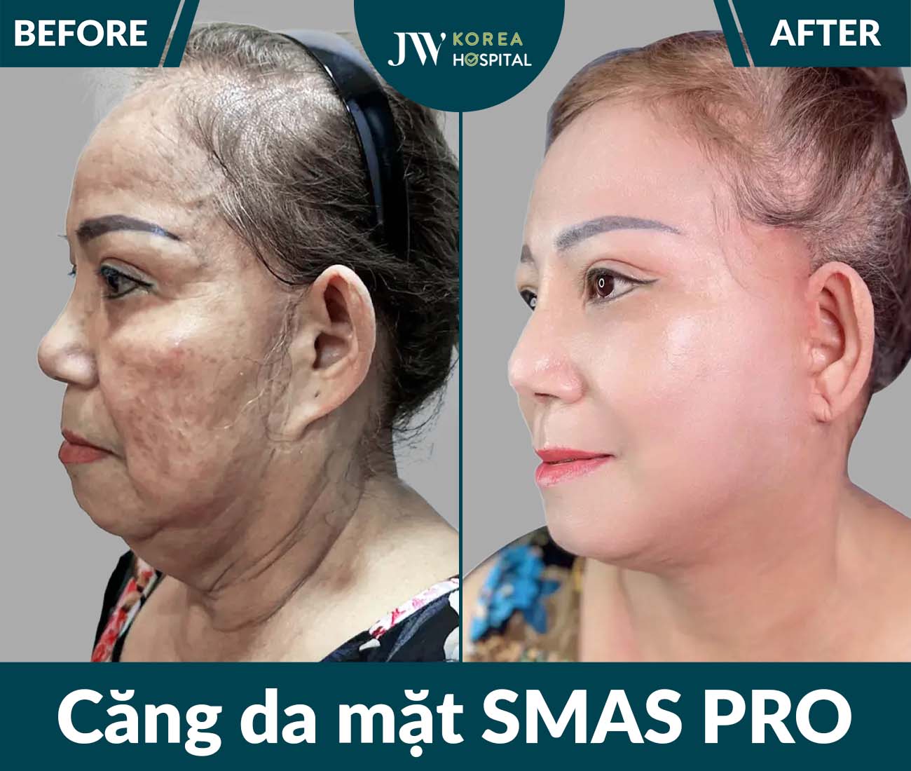 Căng da mặt SMAS PRO