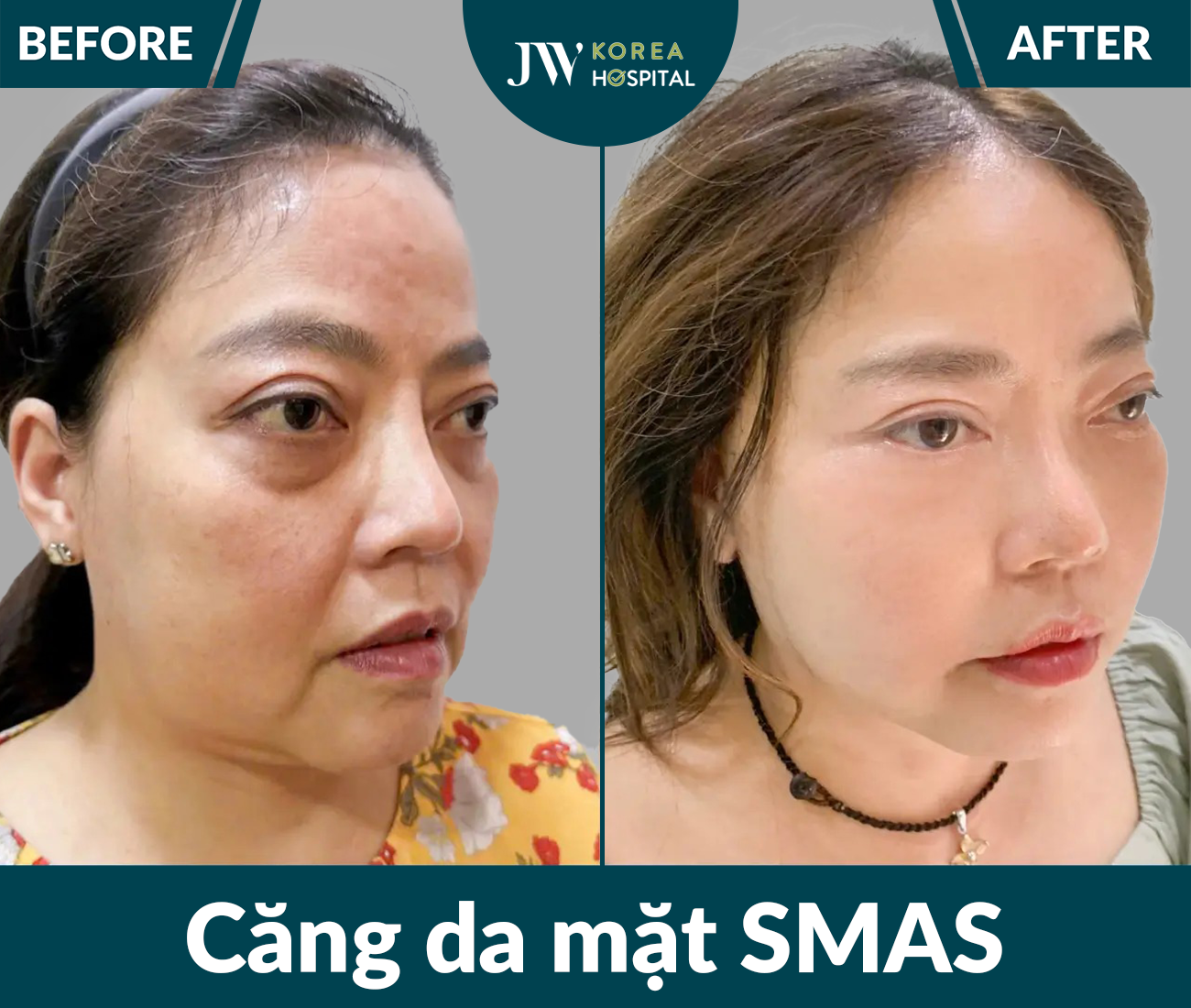 Căng da mặt SMAS PRO