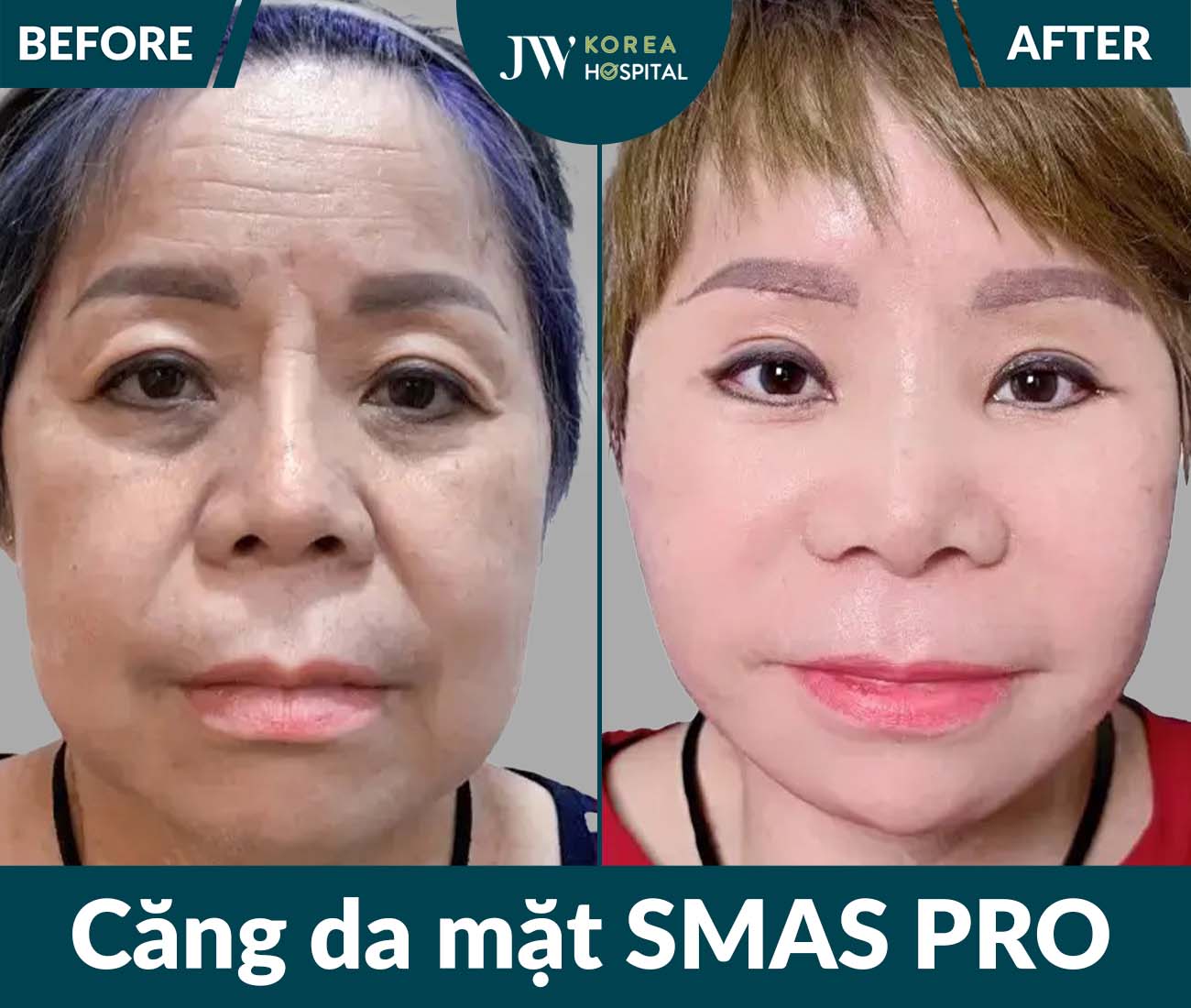 Căng da mặt SMAS PRO