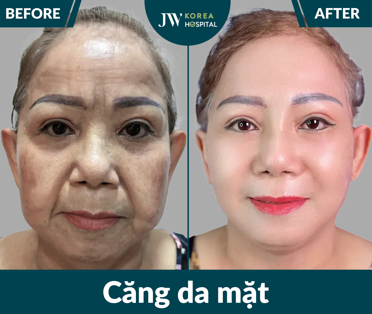 Căng da mặt SMAS PRO