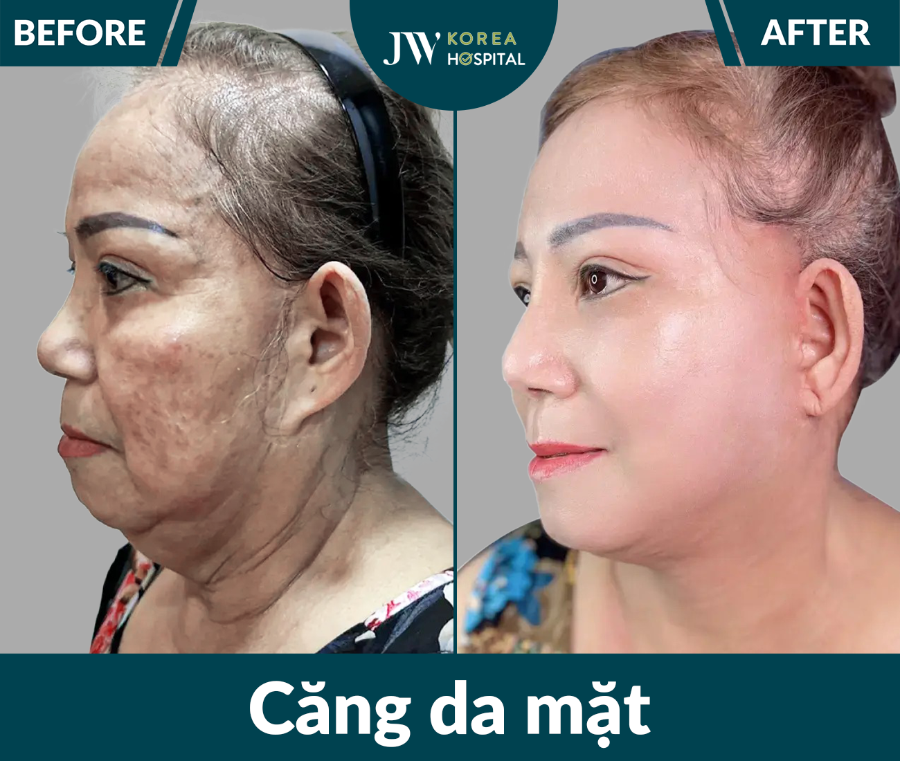 Căng da mặt SMAS PRO