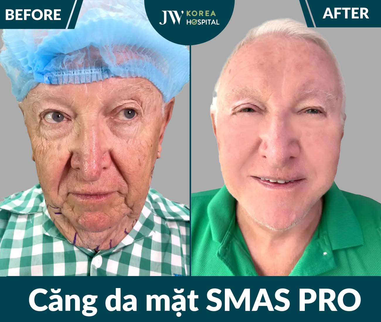 Căng da mặt SMAS PRO