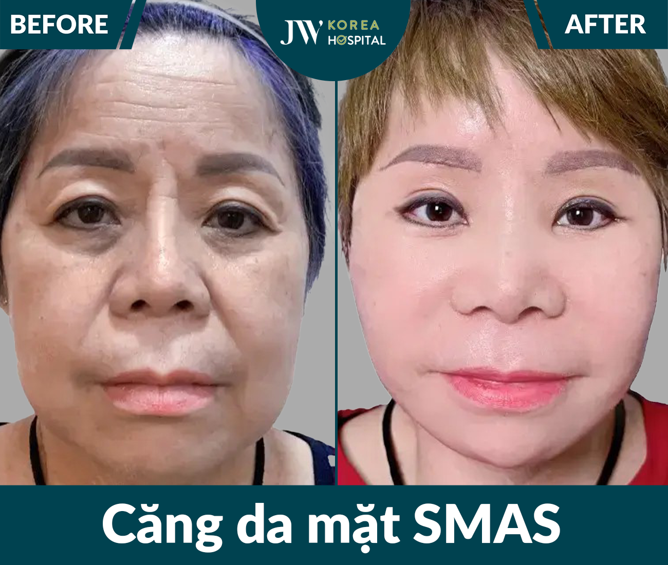 Căng da mặt SMAS PRO