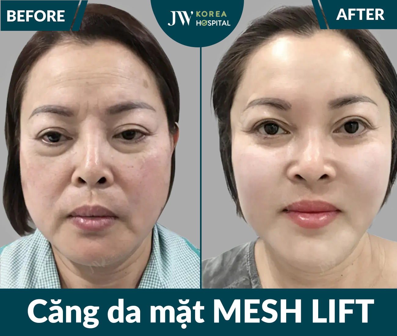 Căng chỉ Meshlift