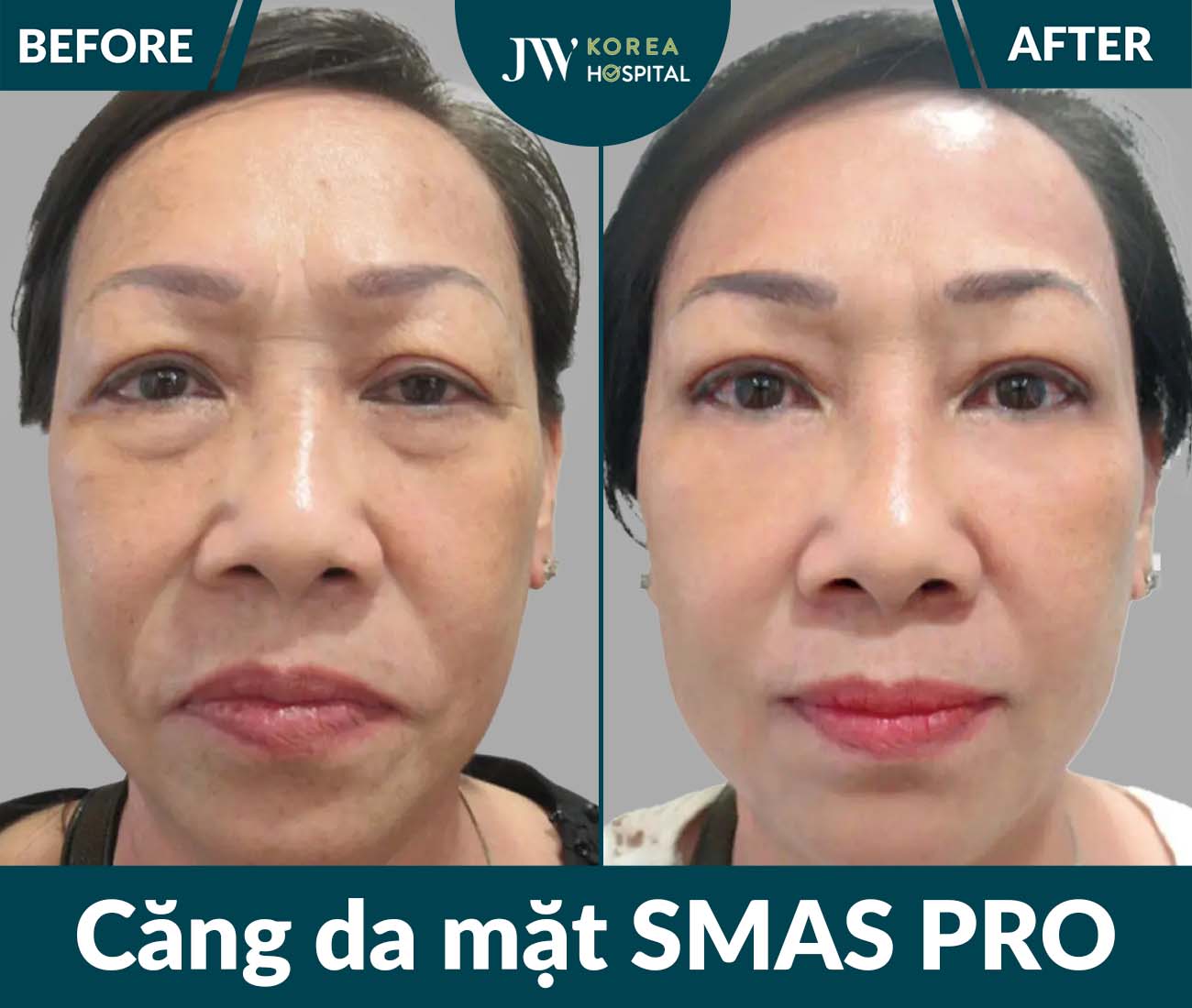 Căng da mặt SMAS PRO