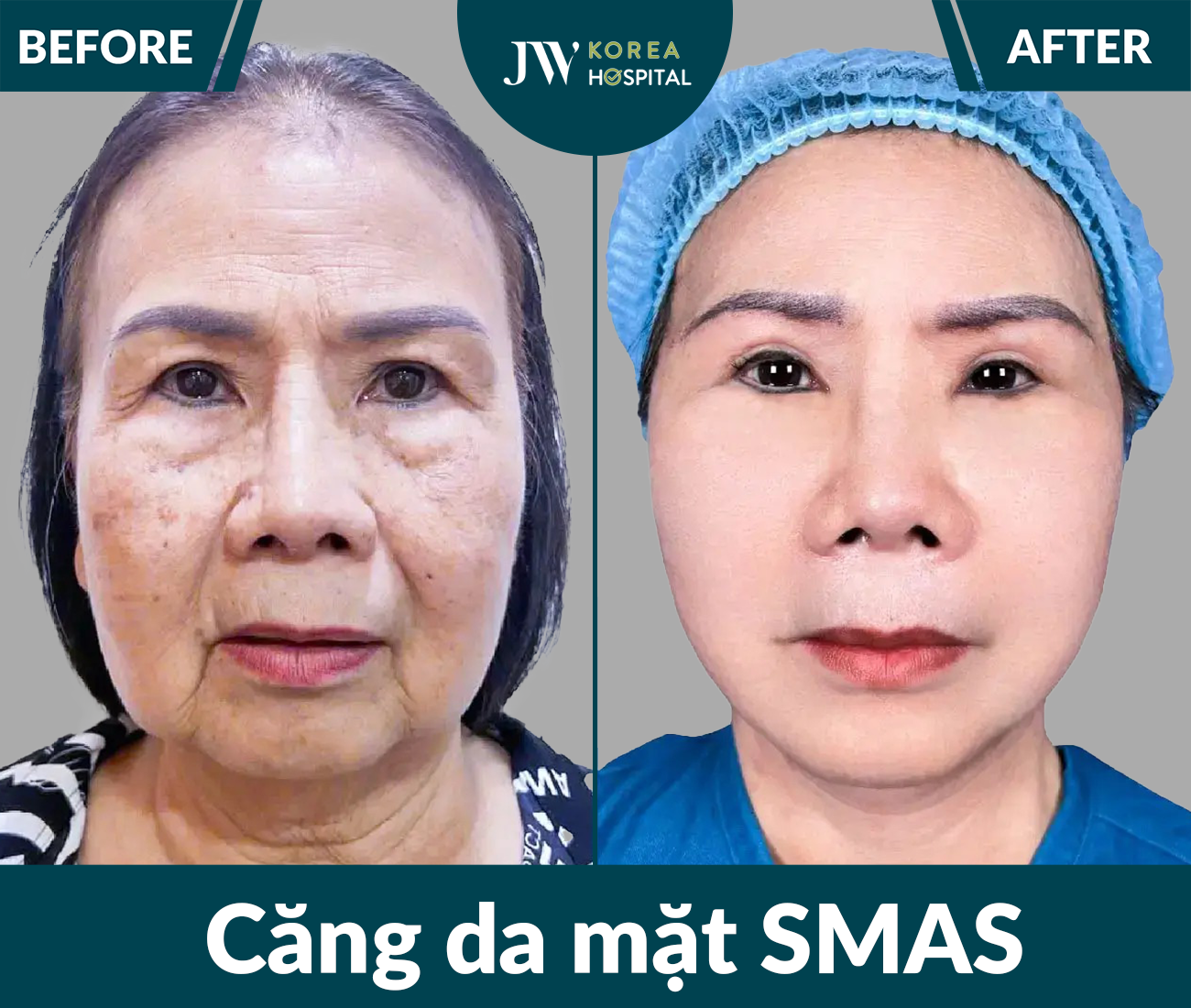 Căng da mặt SMAS PRO