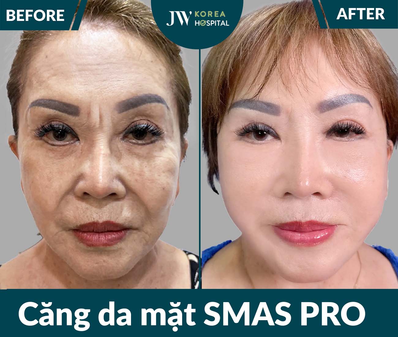 Căng da mặt SMAS PRO