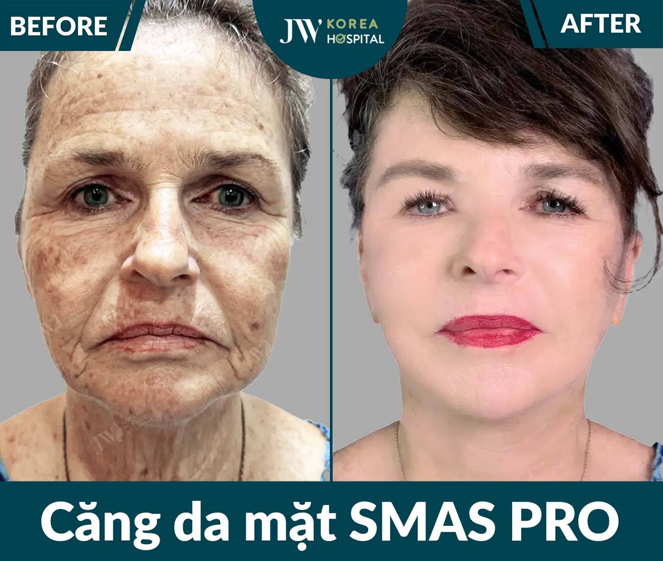 Căng da mặt SMAS PRO