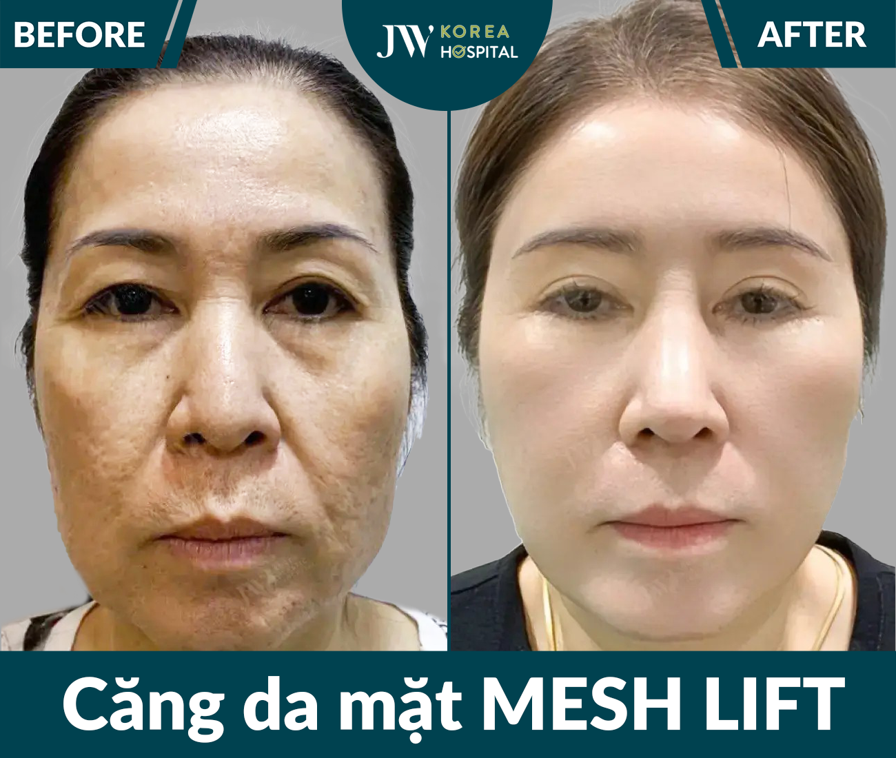 Căng chỉ Meshlift