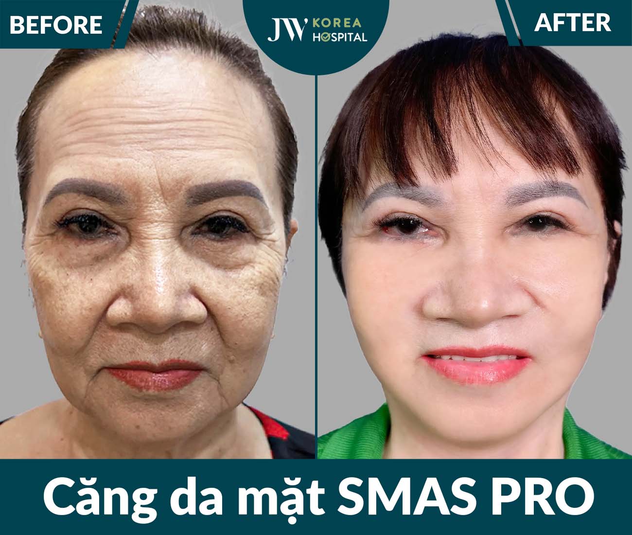 Căng da mặt SMAS PRO