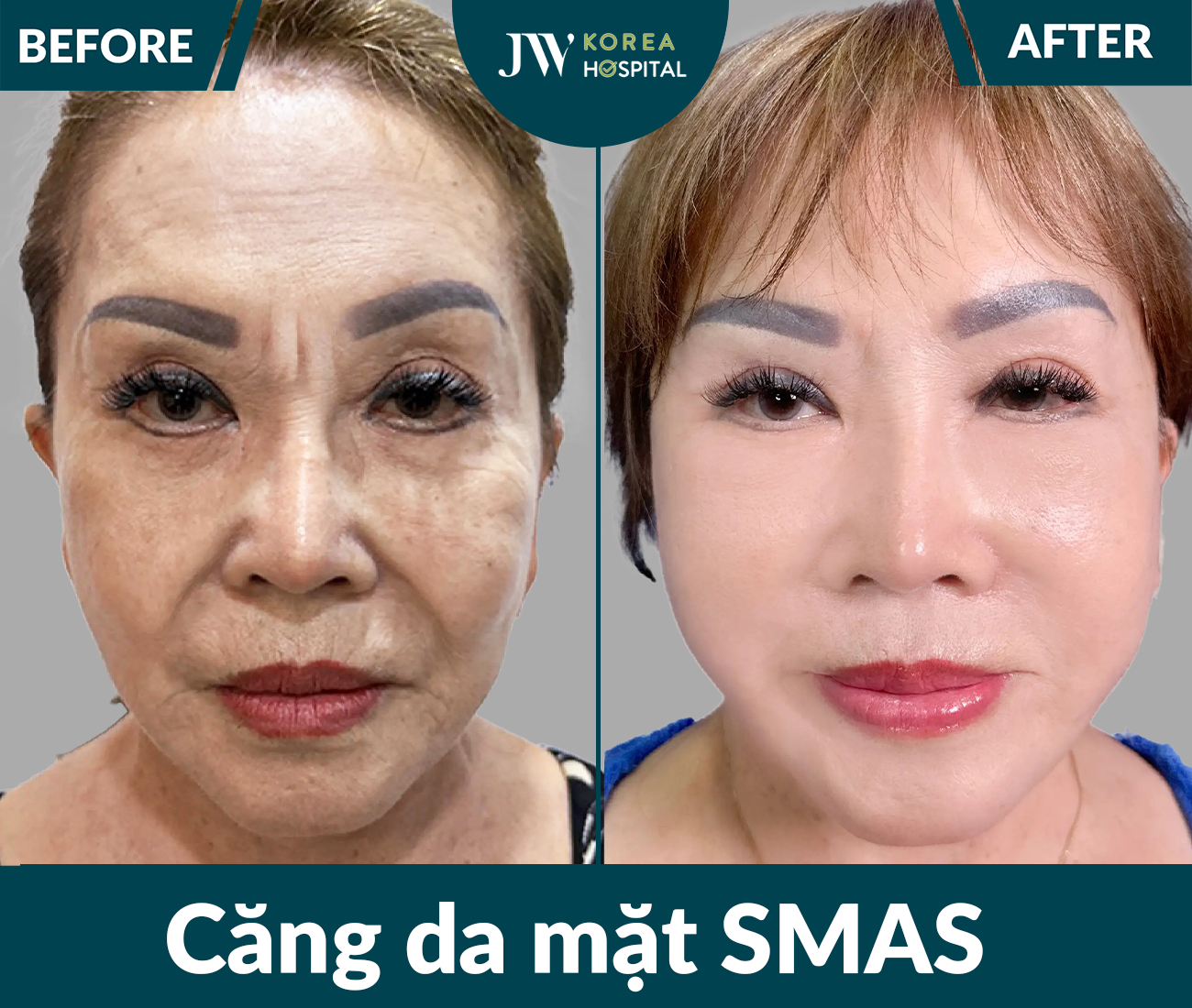Căng da mặt SMAS PRO