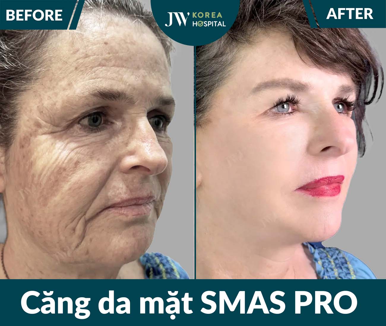 Căng da mặt SMAS PRO