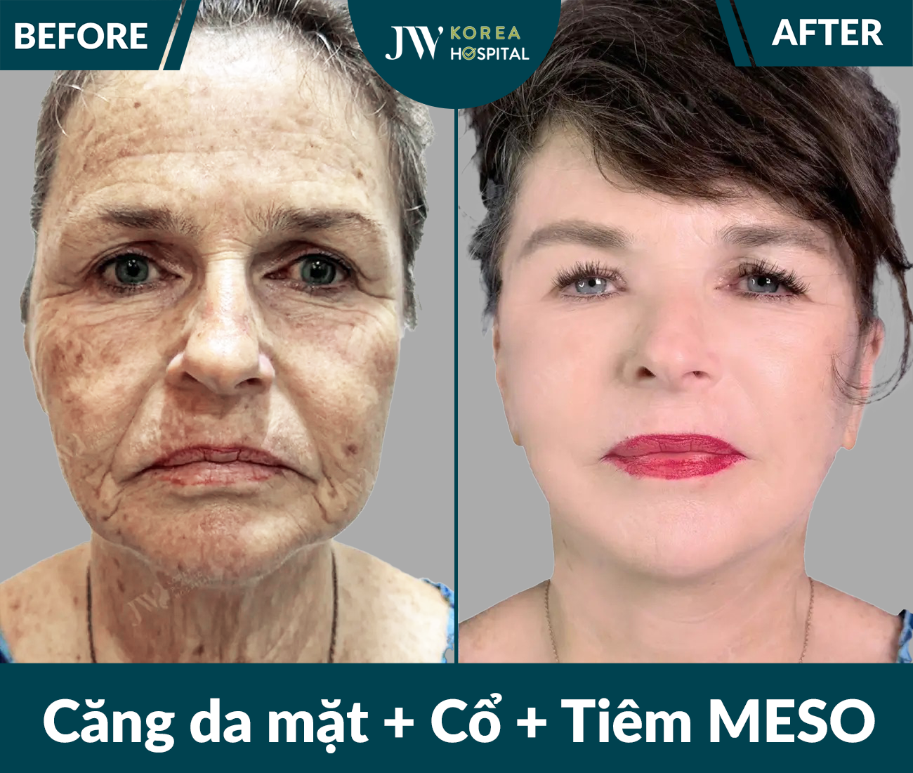 Căng da mặt SMAS PRO