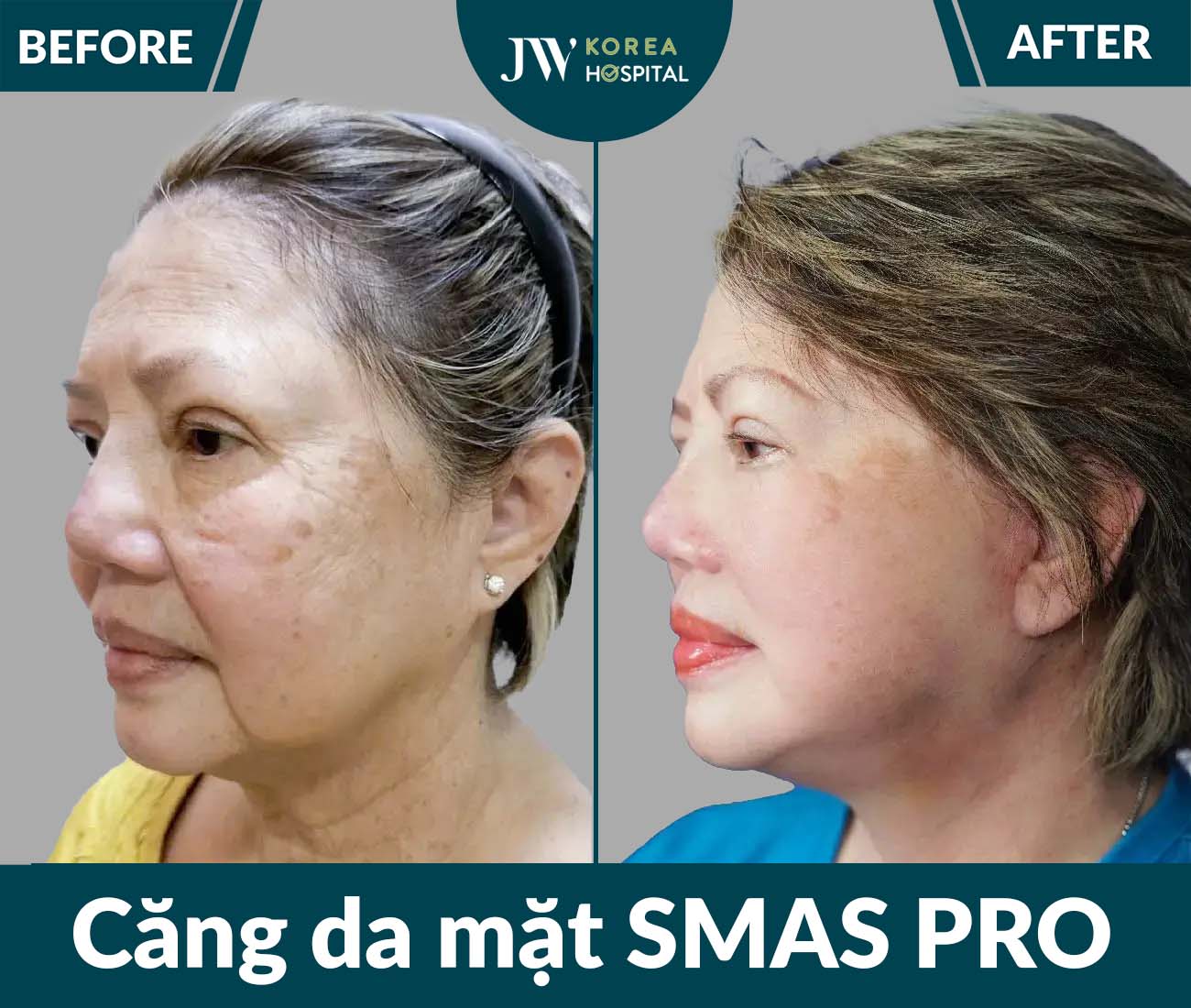 Căng da mặt SMAS PRO