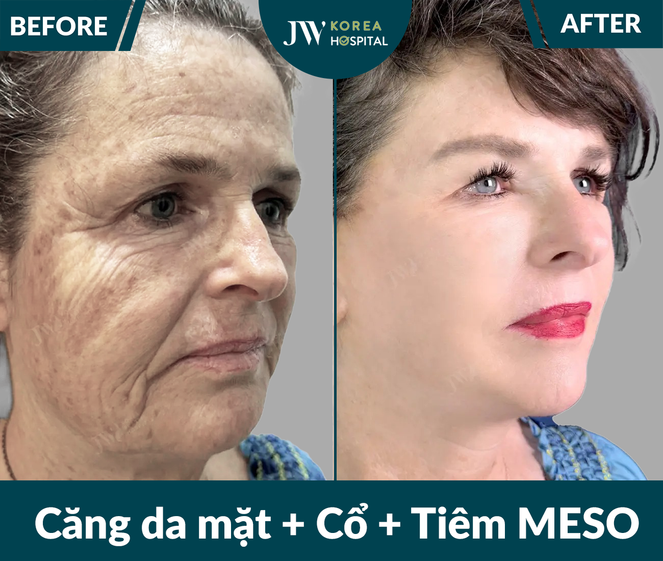 Căng da mặt SMAS PRO