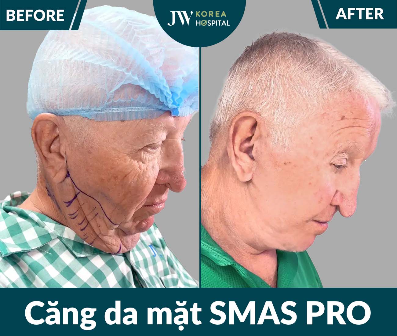Căng da mặt SMAS PRO