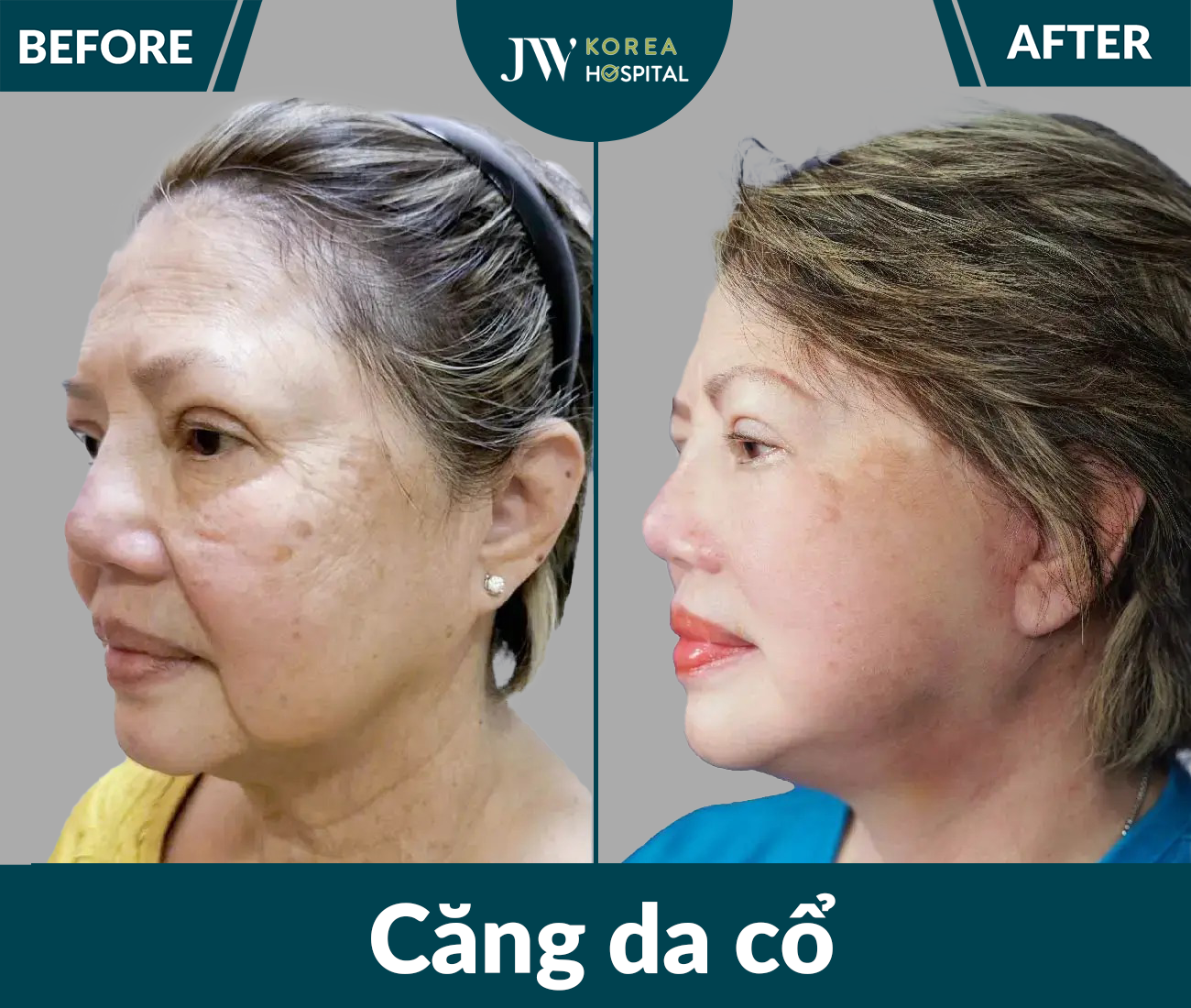 Căng da mặt SMAS PRO