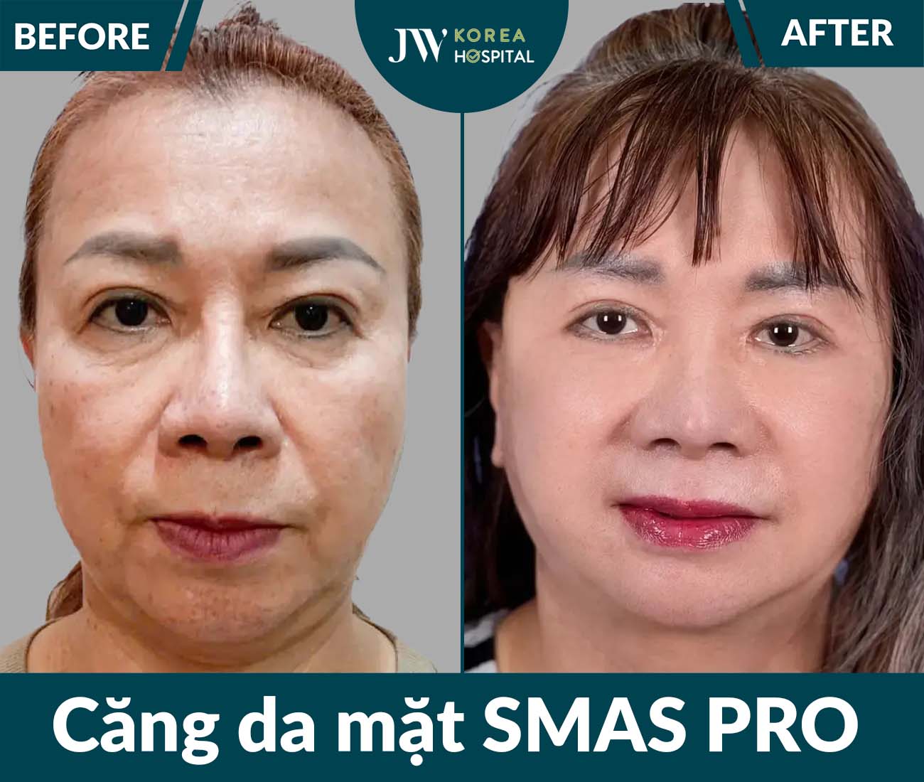 Căng da mặt SMAS PRO