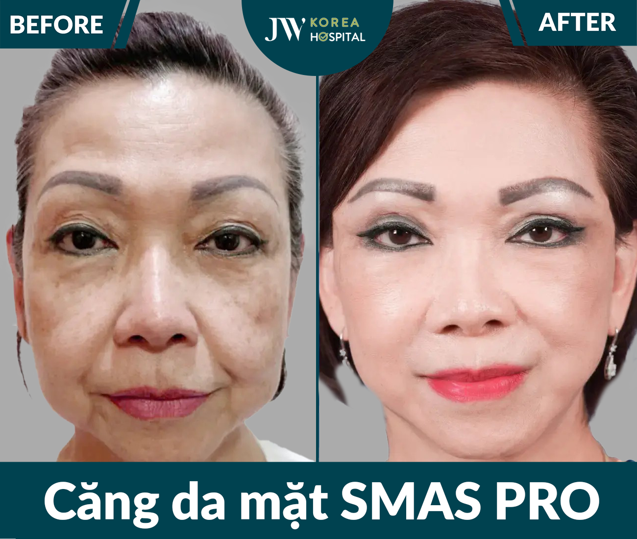 Căng da mặt SMAS PRO