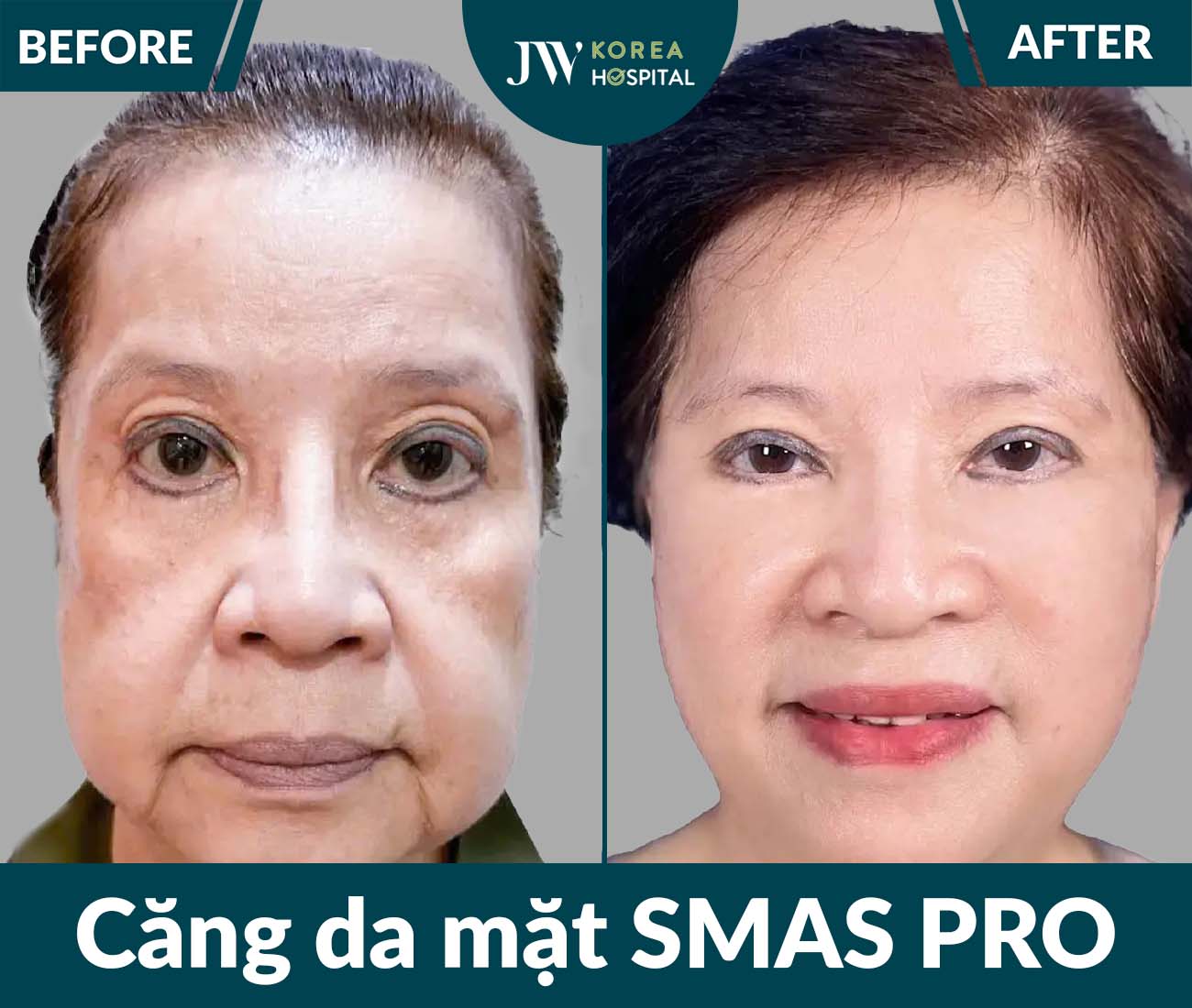 Căng da mặt SMAS PRO