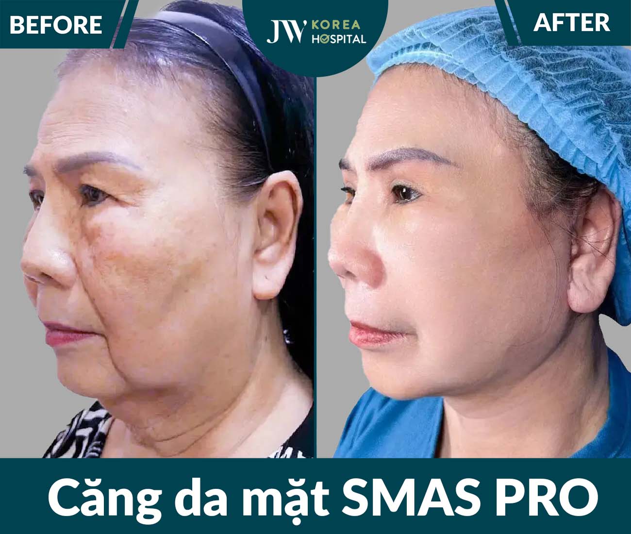 Căng da mặt SMAS PRO