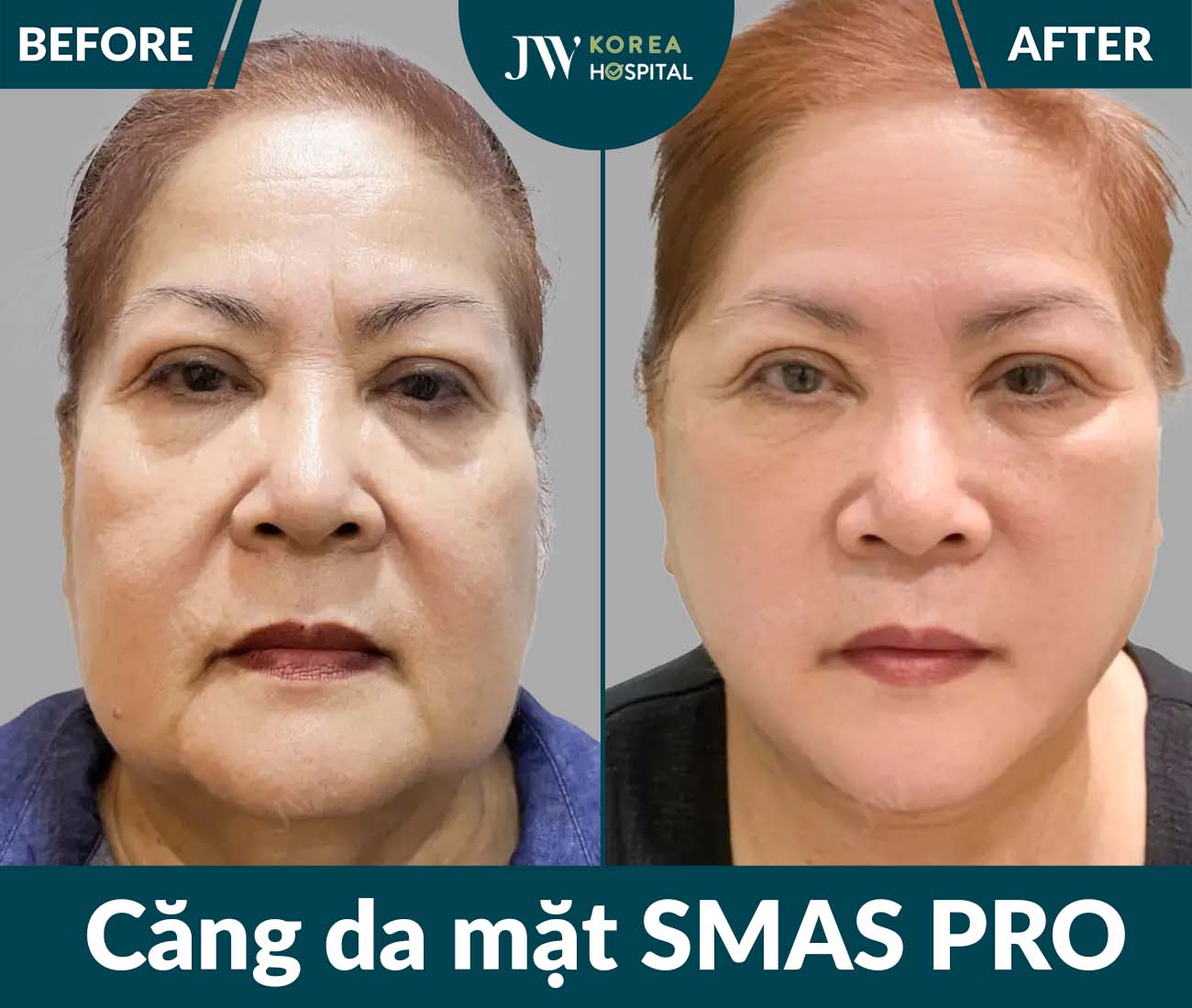 Căng da mặt SMAS PRO