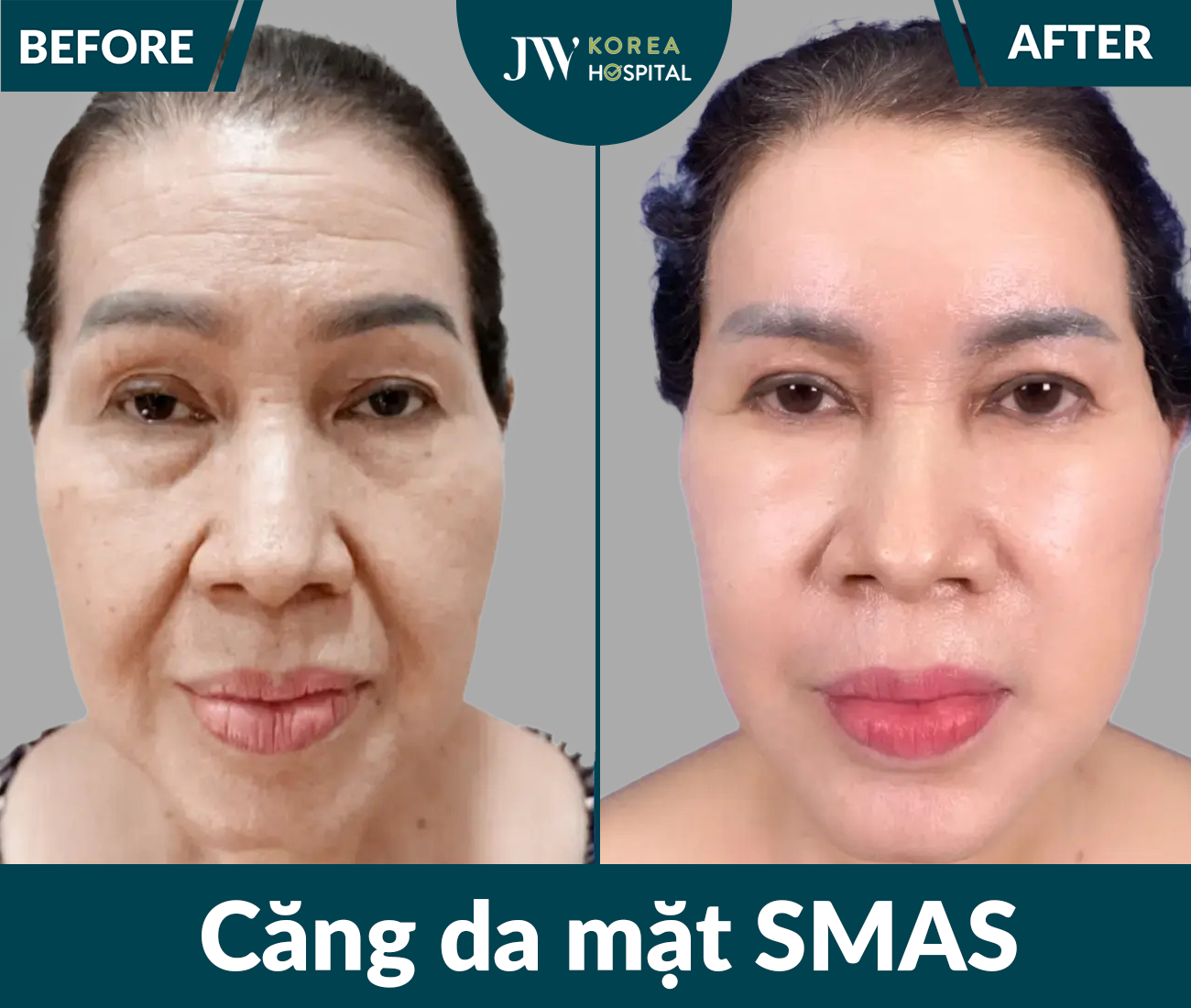 Căng da mặt SMAS PRO