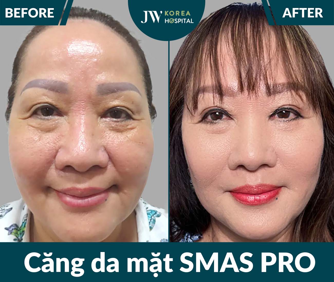 Căng da mặt SMAS PRO